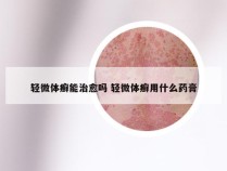 轻微体癣能治愈吗 轻微体癣用什么药膏