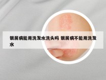 银屑病能用洗发水洗头吗 银屑病不能用洗发水