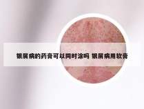 银屑病的药膏可以同时涂吗 银屑病用软膏