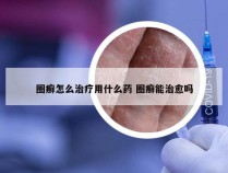 圈癣怎么治疗用什么药 圈癣能治愈吗