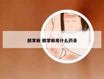 鹅掌癣 鹅掌癣用什么药膏