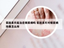 氨肽素片能治愈银屑病吗 氨肽素片对银屑病效果怎么样