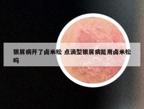 银屑病开了卤米松 点滴型银屑病能用卤米松吗