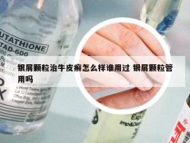 银屑颗粒治牛皮癣怎么样谁用过 银屑颗粒管用吗