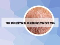 银屑病和口腔麻木 银屑病和口腔麻木有关吗