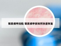 银屑病甲凹陷 银屑病甲损如何快速恢复