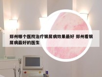 郑州哪个医院治疗银屑病效果最好 郑州看银屑病最好的医生