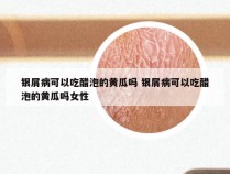 银屑病可以吃醋泡的黄瓜吗 银屑病可以吃醋泡的黄瓜吗女性