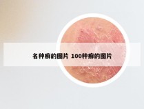 名种癣的图片 100种癣的图片