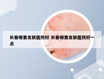 长春哪里皮肤医院好 长春哪里皮肤医院好一点