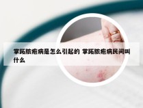 掌跖脓疱病是怎么引起的 掌跖脓疱病民间叫什么