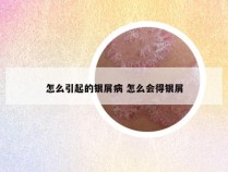 怎么引起的银屑病 怎么会得银屑