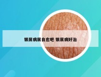 银屑病屑自愈吧 银屑病好治