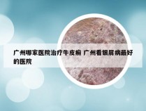 广州哪家医院治疗牛皮癣 广州看银屑病最好的医院