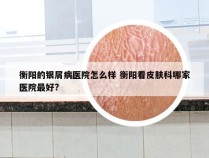 衡阳的银屑病医院怎么样 衡阳看皮肤科哪家医院最好?