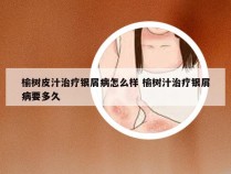 榆树皮汁治疗银屑病怎么样 榆树汁治疗银屑病要多久