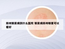 郑州银屑病到什么医院 银屑病郑州哪里可以看好