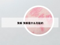 发癣 发癣是什么引起的