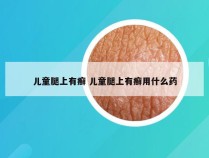 儿童腿上有癣 儿童腿上有癣用什么药