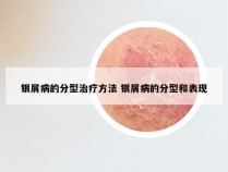 银屑病的分型治疗方法 银屑病的分型和表现