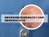 成都市银屑病医院把银屑病治疗好了没有啊 成都银屑病治疗多少钱