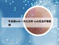 牛皮癣uvb一次几分钟 uvb光治疗银屑病