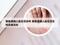 银屑病病人能吃花生吗 银屑病病人能吃花生吗百度百科