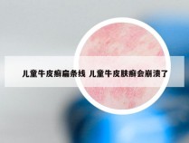 儿童牛皮癣扁条线 儿童牛皮肤癣会崩溃了