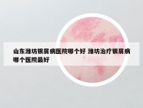 山东潍坊银屑病医院哪个好 潍坊治疗银屑病哪个医院最好