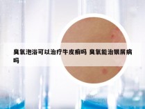 臭氧泡浴可以治疗牛皮癣吗 臭氧能治银屑病吗