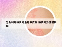 怎么利用徐长卿治疗牛皮癣 徐长卿外洗银屑病