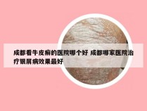 成都看牛皮癣的医院哪个好 成都哪家医院治疗银屑病效果最好