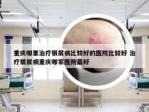 重庆哪里治疗银屑病比较好的医院比较好 治疗银屑病重庆哪家医院最好