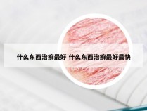 什么东西治癣最好 什么东西治癣最好最快