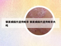 银屑病隔代遗传概率 银屑病隔代遗传概率大吗