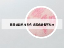 银屑病能用川贝吗 银屑病患者可以吃