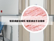 银屑病都会痒吗 银屑病会不会瘙痒