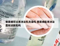 银屑病可以用沐浴乳洗澡吗 银屑病能用沐浴露和润肤乳吗