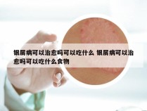 银屑病可以治愈吗可以吃什么 银屑病可以治愈吗可以吃什么食物