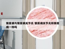 银屑病与银屑病关节炎 银屑病关节炎和银屑病一样吗