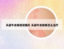 头部牛皮癣症状图片 头部牛皮肤癣怎么治疗