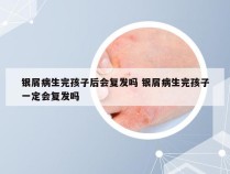 银屑病生完孩子后会复发吗 银屑病生完孩子一定会复发吗