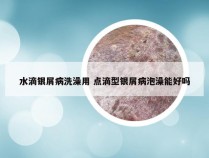 水滴银屑病洗澡用 点滴型银屑病泡澡能好吗