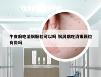 牛皮癣吃消银颗粒可以吗 银屑病吃消银颗粒有用吗