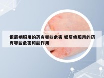 银屑病服用的药有哪些危害 银屑病服用的药有哪些危害和副作用