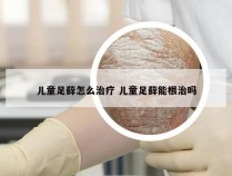 儿童足藓怎么治疗 儿童足藓能根治吗