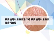 银屑病可以用激素治疗吗 银屑病可以用激素治疗吗女性