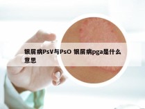 银屑病PsV与PsO 银屑病pga是什么意思