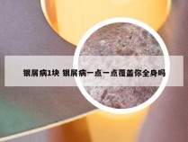 银屑病1块 银屑病一点一点覆盖你全身吗