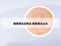 银屑癣该怎样治 银屑癣怎么办